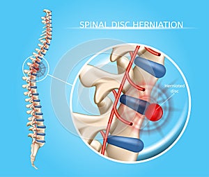 Spinal Disk Herniation Vector Medical Scheme photo