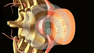 Spinal & Epidural Anaesthesia