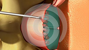 Spinal & Epidural anaesthesia