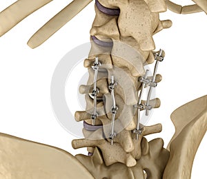 Spinal fixation system - titanium bracket. Medically accurate