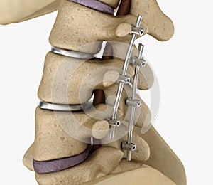 Spinal fixation system - titanium bracket. Medically accurate