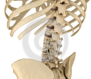 Spinal fixation system - titanium bracket. Medically accurate