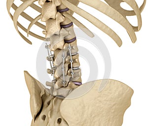 Spinal fixation system - titanium bracket. Medically accurate tooth illustration