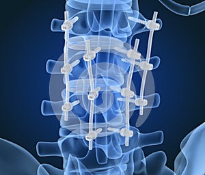 Spinal fixation system - titanium bracket. X-ray view.