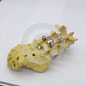 Spinal fixation system - titanium bracket