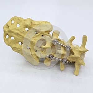 Spinal fixation system - titanium bracket