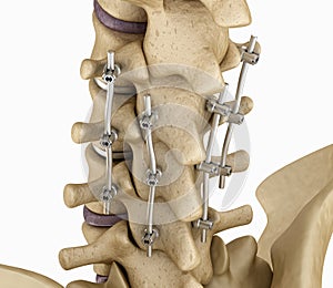 Spinal fixation system - titanium bracket.