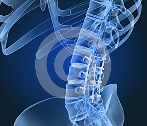 Spinal fixation system - titanium bracket. X-ray view