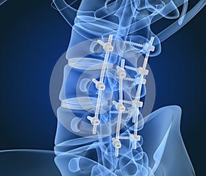 Spinal fixation system - titanium bracket. X-ray view photo