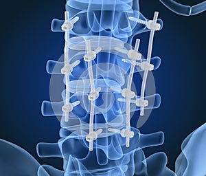 Spinal fixation system - titanium bracket. X-ray view. photo