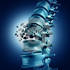 Spinal Fracture