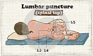 Spinal Lumbar Puncture Illustration on old Paper