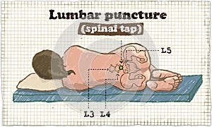 Spinal Lumbar Puncture Illustration on old Paper photo