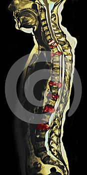 Spine metastases, MRI photo
