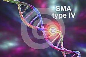 Spinal muscular atrophy, SMA, a genetic neuromuscular disorder