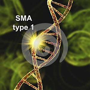 Spinal muscular atrophy, SMA, a genetic neuromuscular disorder