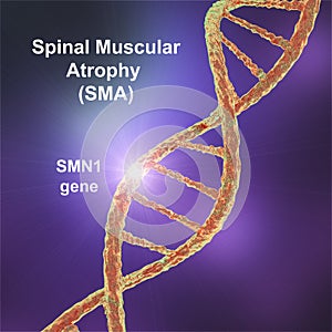 Spinal muscular atrophy, SMA, a genetic neuromuscular disorder