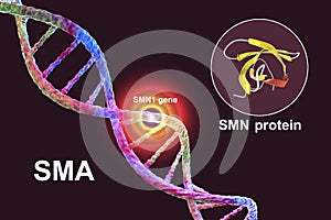 Spinal muscular atrophy, SMA, a genetic neuromuscular disorder with progressive muscle wasting