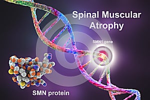 Spinal muscular atrophy, SMA, a genetic neuromuscular disorder with progressive muscle wasting