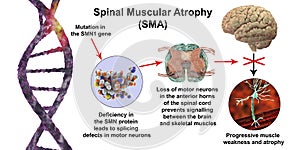 Spinal muscular atrophy, SMA, a genetic neuromuscular disorder with progressive muscle wasting