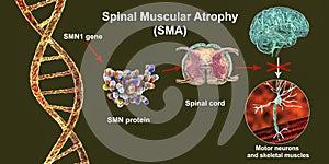 Spinal muscular atrophy, SMA, a genetic neuromuscular disorder with progressive muscle wasting