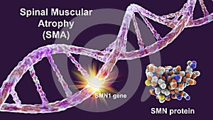 Spinal muscular atrophy, SMA, a genetic neuromuscular disorder with progressive muscle wasting