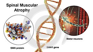 Spinal muscular atrophy, SMA, a genetic neuromuscular disorder with progressive muscle wasting