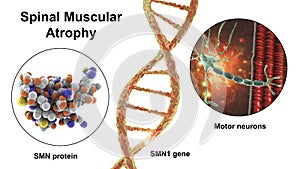 Spinal muscular atrophy, SMA, a genetic neuromuscular disorder with progressive muscle wasting photo