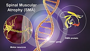 Spinal muscular atrophy, SMA, a genetic neuromuscular disorder with progressive muscle wasting photo