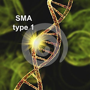 Spinal muscular atrophy, SMA, a genetic neuromuscular disorder photo