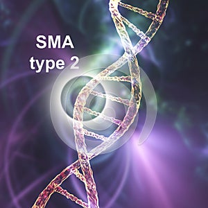 Spinal muscular atrophy, SMA, a genetic neuromuscular disorder photo