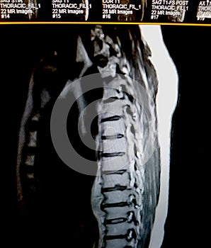 Spinal prevertebral phlegmon due to vertebral osteomyelitis