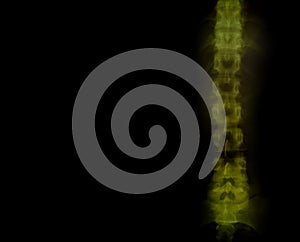 Spinal roentgenogram photo