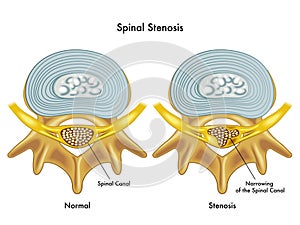 Spinal stenosis