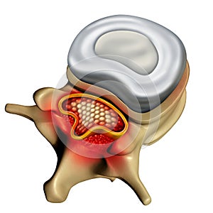 Spinal Stenosis Concept photo