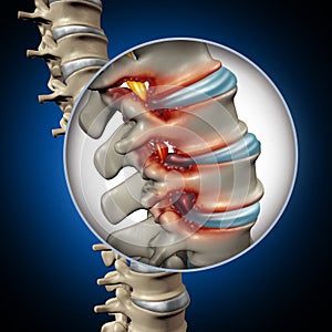 Spinal Stenosis Medical Concept photo