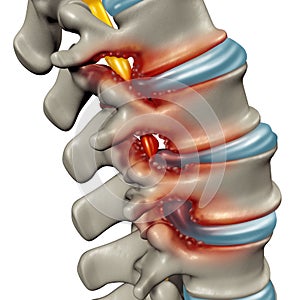 Spinal Stenosis Medical Condition photo
