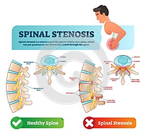 Spinal stenosis vector illustration. Labeled medical scheme. Diagram with nucleus, annulus, bone spurs and compressed spinal nerve photo