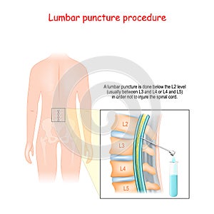Spinal Tap Procedure. Detailed diagram of lumbar puncture