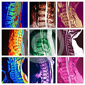 Spinale colonna vertebrale patologia colorato 