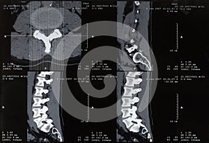 Spinal xray, spine side view