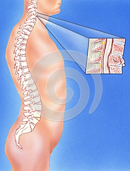 Spine - Broken Neck showing Cervical Vertebra Fracture photo