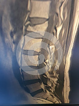 spine with broken vertebrae. Xray Back risonanza photo