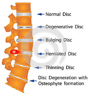 Columna vertebral condiciones 