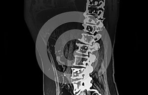 Spine CT Scan showing metastatic tumoral lesions