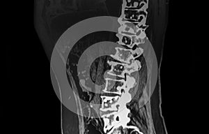 Spine CT Scan showing metastatic tumoral lesions photo