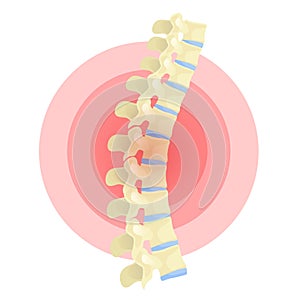 Spine deformation flat vector color isolated illustration