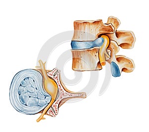 Spine - Herniated Slipped or Ruptured Disc photo