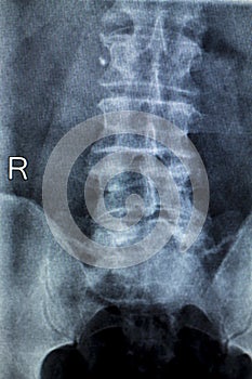 Spine hips Xray test scan