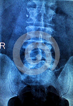 Spine hips Xray test scan